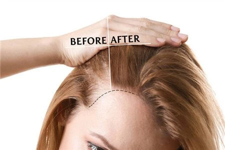 minoxidil female