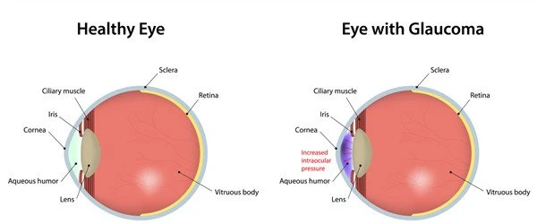 Citicoline powder for Glaucoma