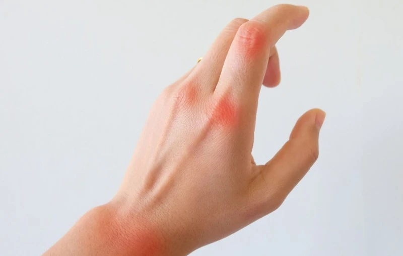 rheumatoid arthritis rheumatoid arthritis