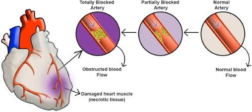 Acute Myocardial Infarction