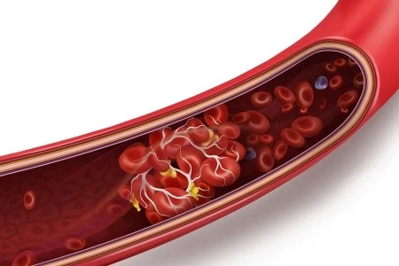 thrombosis
