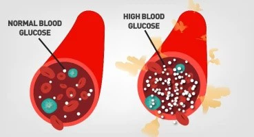 Hyperglycemia Elevated Blood Sugar Levels
