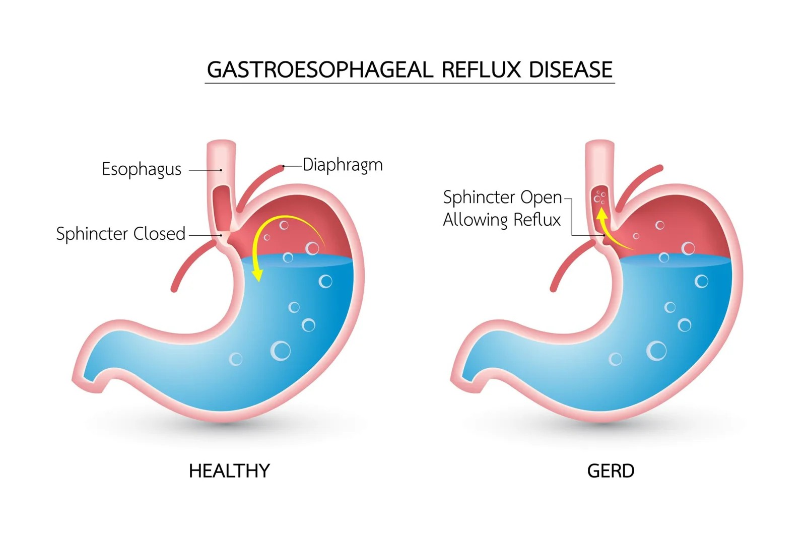 gastroesophageal reflux disease