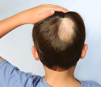 ¿Qué tan duro intentaban los antiguos tratar la caída del cabello?