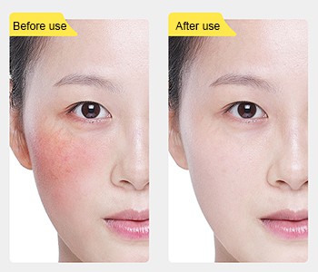 El 【【【【】】】】】 de barrera de piel - ectoin