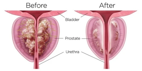 Reduction of Prostate Size